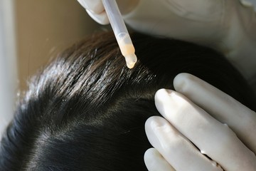Doctor giving a treatment at patient's hair and scalp, Close up shot of Dermatologist exam scalp disorder.