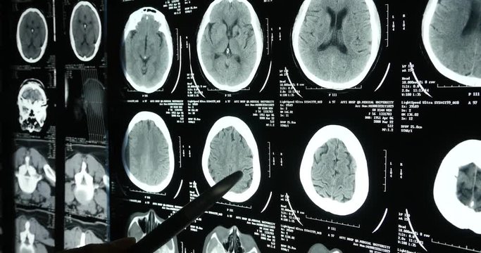 Doctors study head skull brain X-ray film for analysis.health medical hospital.