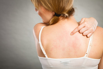 woman scratching her itchy back with allergy rash