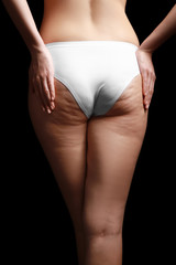 Woman with cellulite problem on black background