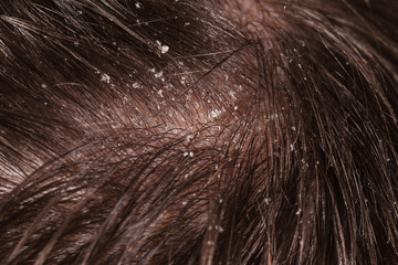 Dandruff on male dark hair