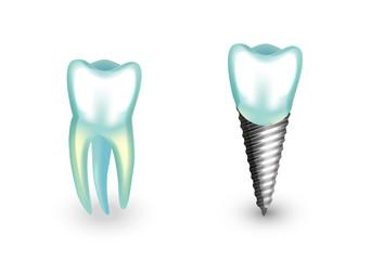 a dental implant. orthodontics