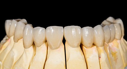 Dental ceramic bridge