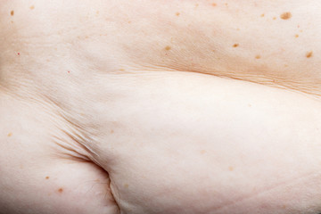 Nevus on human skin, obesity