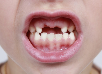 Fototapeta premium Closeup of child's month with missing teeth
