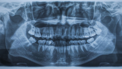 Panoramic dental X-Ray
