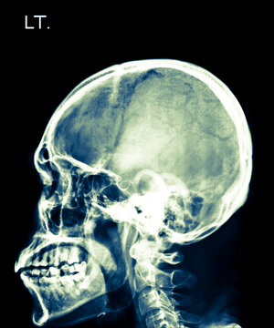 X-ray of head, skull in  left side