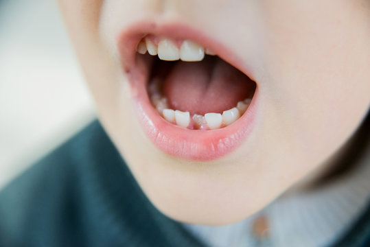 Childish cute mouth with beautiful lips and missing milk teeth dental health care and hygiene six years old toothless kid child closeup, horizontal picture