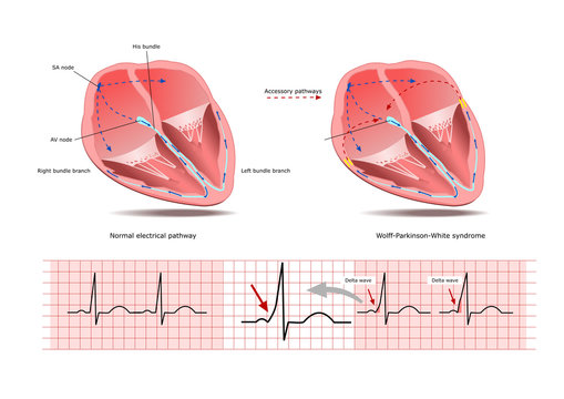 The Wolff-Parkinson-White (WPW) syndrome, a condition of altered electrical signaling, and two electrocardigrams showing the differencese (delta wave).
