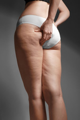 Woman with cellulite problem on dark background - obrazy, fototapety, plakaty