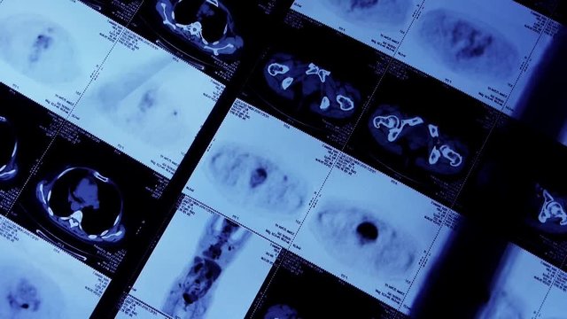 moving human orage pet-ct scan,medical X-ray,Cancer metastasis.