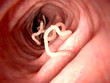Bandwurm in menschlichen Darm.