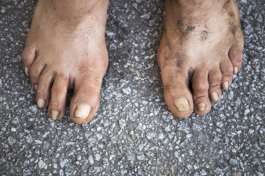 Feet of a human being who lives on the street.