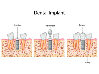 Education Chart of Dental Implant process Diagram