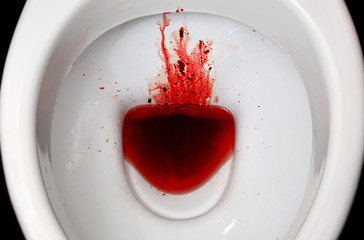 A white ceramic toilet bowl is stained with blood. The consequences of pronounced menstruation,...