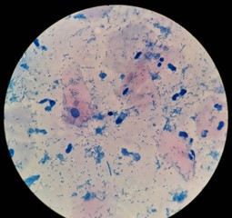 Smear of Acid-Fast bacilli (AFB) stained from sputum specimen with positive Mycobacterium...