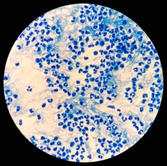 Smear of Acid-Fast bacilli (AFB) stained from sputum specimen with numerous white blood cells...
