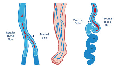 VARICOSE VEIN AND NORMAL VEIN ILLUSTRATION VECTOR