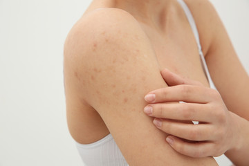 Allergy concept. Woman scratching her shoulder with rash on white background