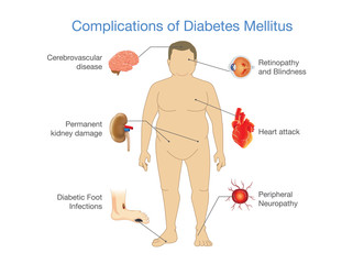 Complications of Diabetes Mellitus in fat people. Illustration in Infographic style about medical and health. - obrazy, fototapety, plakaty