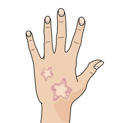 Hand with skin disease on white background