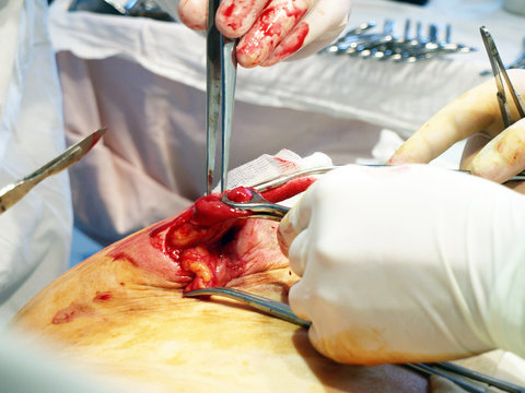 operating. reconstruction of a colostomy. operation process