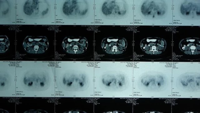 moving human organ pet-ct scan,lymph nodes X-ray,Cancer metastasis.