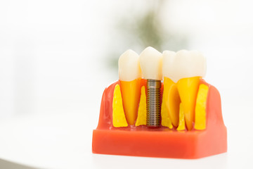 Set of Dentist's equipment tools, denture showing implant
