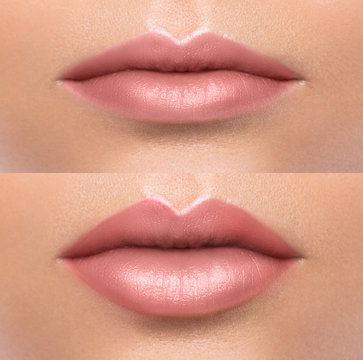 Comparison of female lips after augmentation