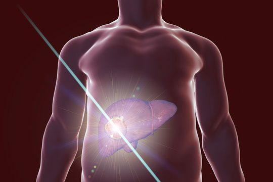 Liver cancer treatment with laser. Conceptual image. 3D illustration
