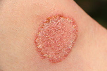 Dermatophytose sur le genou