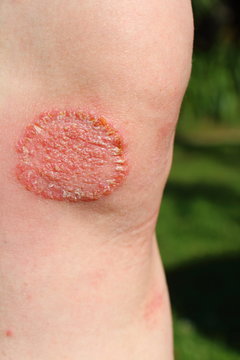 Dermatophytose sur le genou