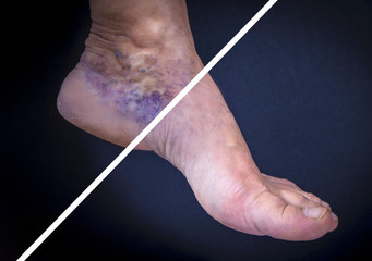 Human foot with varicose veins before and after