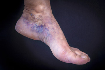 Human foot with varicose veins