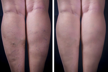 Human legs with varicose veins