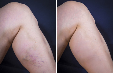 Human leg with varicose veins before and after treatment