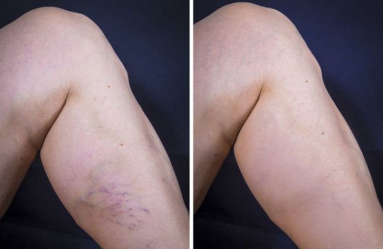 Human leg with varicose veins before and after treatment