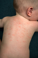 Naklejka premium Allergies, pimples on the baby's skin. Food allergy.