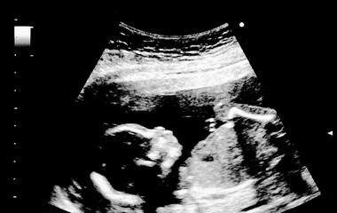 An ultrasound of a human fetus during the 18 week.
