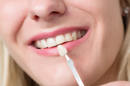 Zahnfarbe für Zahnersatz aussuchen