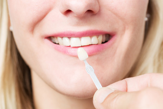 Zahnfarbe für Zahnersatz aussuchen