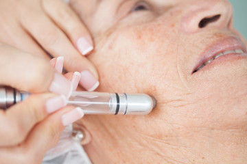 Microdermabrasion treatment on a senior woman face