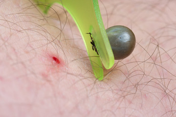 Eine vollgesaugte Zecke bzw. Holzbock (Ixodes ricinus) wird aus der menschlichen Haut entfernt