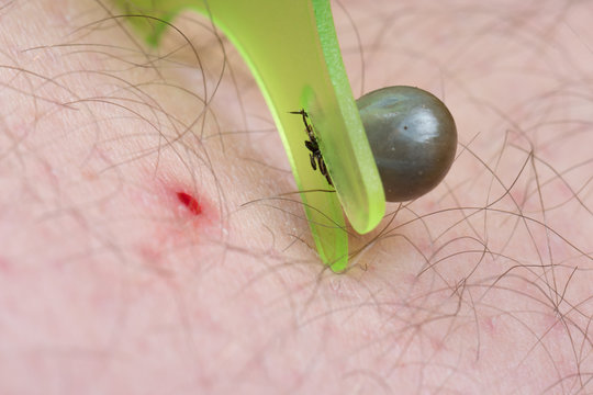 Eine vollgesaugte Zecke bzw. Holzbock (Ixodes ricinus) wird aus der menschlichen Haut entfernt