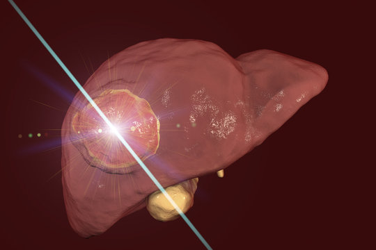 Liver cancer treatment with laser. Conceptual image. 3D illustration