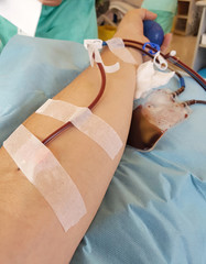 Arm of a man while donating blood