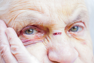 Injured elderly woman's eyes & face