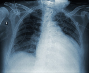 X-ray of patient with heart disease after surgery