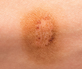 Fototapeta premium Ringworm on the skin