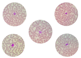 Blood smear under microscope present neutrophil, lymphocyte, monocyte, eosinophil and basophil ,...